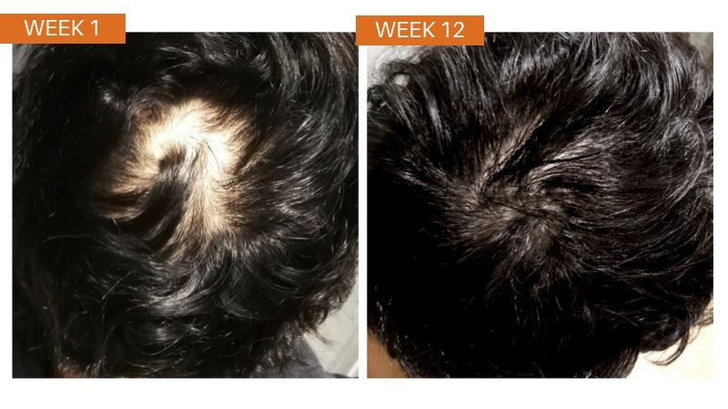 HR23+® Hair Restoration Supplement for Hair Loss